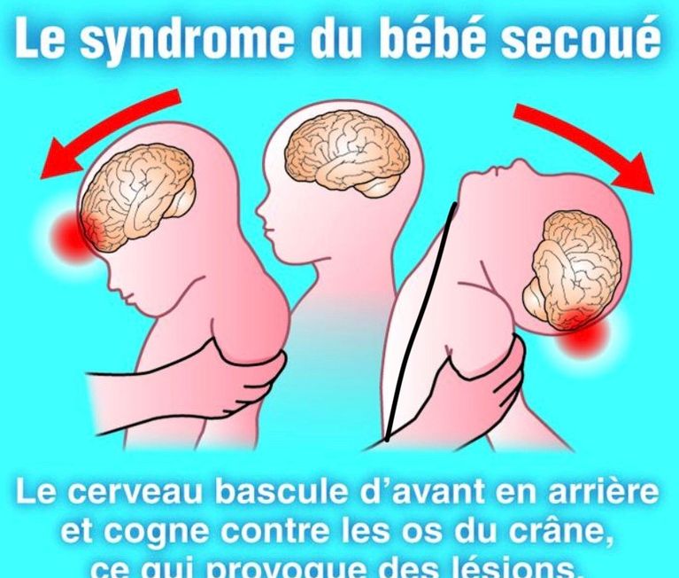 Le syndrome du bébé secoué